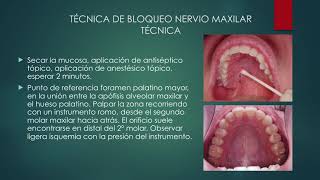 Anestesia dental nervio maxilar Universidad Austral Chile [upl. by Daeriam124]