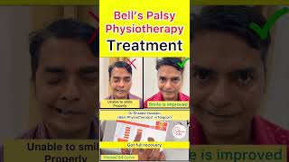 Bell’s palsy Physiotherapy Treatment Results bellspalsy physiotherapy shorts [upl. by Honig289]