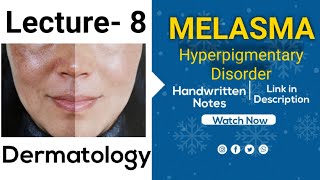 Melasma  Hyperpigmented Disorder  Dermatology Lecture  8  With Handwritten Notes for NEET PG [upl. by Blatt524]