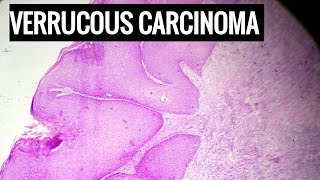 Verrucous Carcinoma Histopathology [upl. by Konopka77]