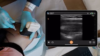 Suprascapular Nerve Block [upl. by Westberg]