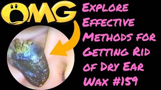 Explore Effective Methods for Getting Rid of Dry Ear Wax 159 [upl. by Storer]