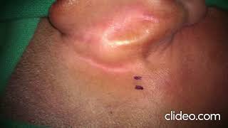 Marking an Incision  How to start Ear surgery  Postaural incision  Tympanoplasty  Mastoidectomy [upl. by Antonia]