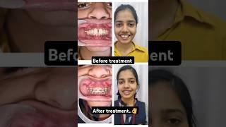 Midline diastema gaps in front tooth frenectomy Drswetakaushik orthodontist dentist [upl. by Felix]