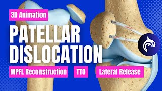 How Its Fixed  Patellar Dislocation MPFL Repair Tibial Tubercle Osteotomy and Lateral Release [upl. by Flo866]