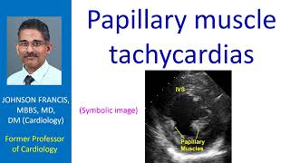 Papillary muscle tachycardias [upl. by Ona]