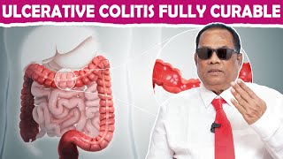 ULCERATIVE COLITIS FULLY CURABLE  DRCKNandagopalan [upl. by Acino]