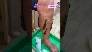 Can leeches treat varicose veins  LEECH THERAPY kzhijamaleechleechtherapyvaricoseveinsshorts [upl. by Eiveneg806]