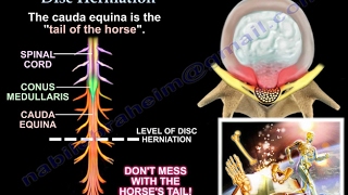 Disc Herniation  Everything You Need To Know  Dr Nabil Ebraheim [upl. by Rangel]