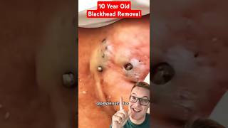 Crazy 10 Year Old BLACKHEADS REMOVAL shorts [upl. by Einitsed512]