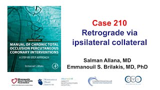 Case 210 Manual of CTO PCI  Retrograde via ipsilateral collateral [upl. by Aniz]