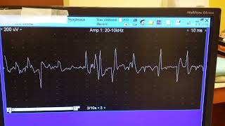 hypoglossal myokymia 3 [upl. by Neumeyer233]