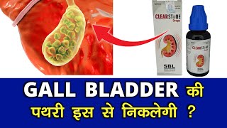 ऐसा है क्या  clearstone drops for gallbladder  Gb stones  SBL Clear stone drop  Dr tarun [upl. by Anel]