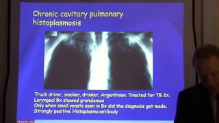 Diagnosis and treatment of chronic pulmonary aspergillosis [upl. by Aila405]