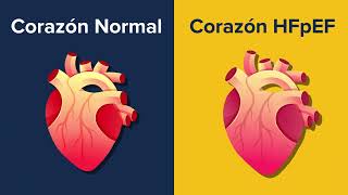 Estudio clínico para aprender más sobre HFpEF falla cardiaca e identificar futuros tratamientos [upl. by Ahsiri246]