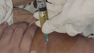 Joint Fluid Aspiration  Removing fluid from Inflammed Joint jointpain arthritis [upl. by Gawen]