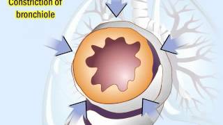 COPD Pathophysiology and Diagnosis [upl. by Pearla614]