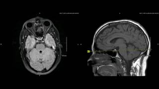 Unremarkable Non Contrast Brain MRI Axial FLAIR Example 1 [upl. by Atinus502]