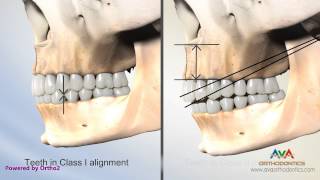 Malocclusion  Overjet Overbite Secondary to Vertical Maxillary Excess [upl. by Accissej]