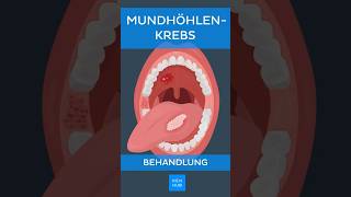 Mundhöhlenkrebs Behandlung  Kenhub shorts [upl. by Yedarb]