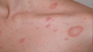 Pityriasis rosea English version [upl. by Sprage603]