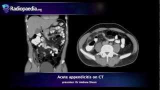 Acute appendicitis on CT  radiology video tutorial [upl. by Nyrehtak]