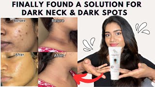 Dark neck amp Hyperpigmentation treatment  Acanthosis Nigricans treatment [upl. by Ahtaela]