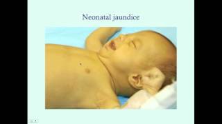 Introduction to Newborn Jaundice  CRASH Medical Review Series [upl. by Low273]