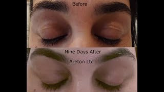 Plasma Upper Eyelids Tightening training Before Healing and Afters [upl. by Ahsinoj]