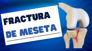 FRACTURA de la MESETA TIBIAL doctorjuancarlosalbornoz fracturademeseta [upl. by Thurmond]