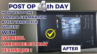 4th Day Control Examination after Varicocele Surgery [upl. by Octavian]