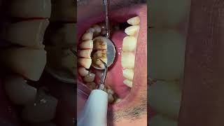 Diş taşı temizliğiTooth stone cleaningDental asmr video [upl. by Liesa869]