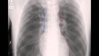 Chest xray interpretation in ICU [upl. by Kcirdehs]