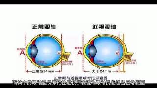 近視手術能解決眼睛變形、眼球突出嗎？ [upl. by Auhsaj]