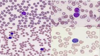 Mantle cell lymphoma 1 17 3 23 [upl. by Alyam]