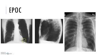 REPASO RX TÓRAX NEUMONÍAEPIDEPOCMICOSIS PULMONARTBC [upl. by Ofloda752]