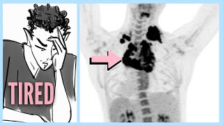 LYMPHOMA After Ignoring 6 WARNING Signs [upl. by Caria719]