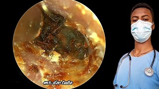 🔴Revolutionary Ear Wax Removal Doctor’s Top Tips”earearwax earwaxremovalearwaxcleaningasmr [upl. by Fauman]