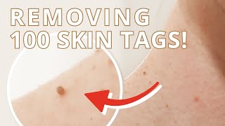 100 Skin Tags Removed from My Neck – 2 Weeks Before amp After ft Q Esthetics [upl. by Toogood921]