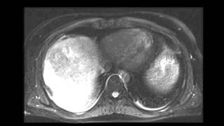 Large hepatocellular carcinoma HCC [upl. by Rudolph]