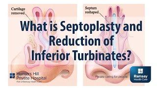 What is Septoplasty and reduction of Inferior Turbinates [upl. by Elleval]