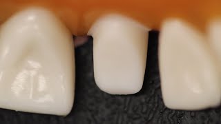 All Ceramic Crown Anterior Tooth Preparation [upl. by Oyr]