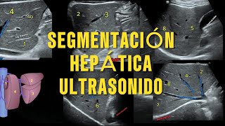 Segmentación Hepática de Couinaud por Ultrasonido La Guía Esencial para Radiología [upl. by Deehsar]