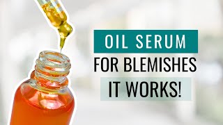 Get Rid of Blemishes with This Serum Formula  It Works [upl. by Ariem]