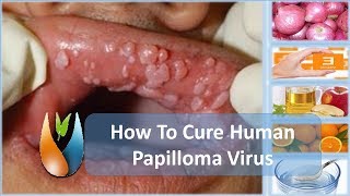 How To Cure Human Papilloma Virus [upl. by Ynnal]