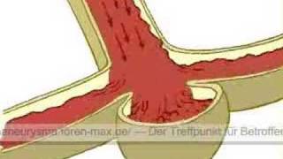 Die Entstehung eines AneurysmasHirnaneurysmas [upl. by Mehetabel]