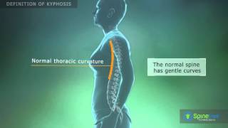 Kyphosis Definition [upl. by Eseyt]