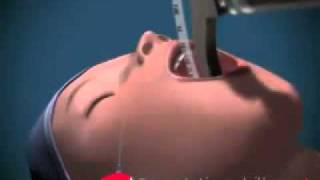 intubation endotracheal [upl. by Mara235]