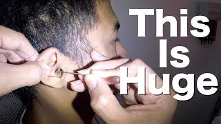 Young Mans Earwax Chunk Removed using Hydrogen Peroxide [upl. by Tybi260]