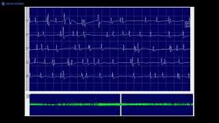 Kimura amp Kohara F9 EP spike without EP noise [upl. by Yldarb]